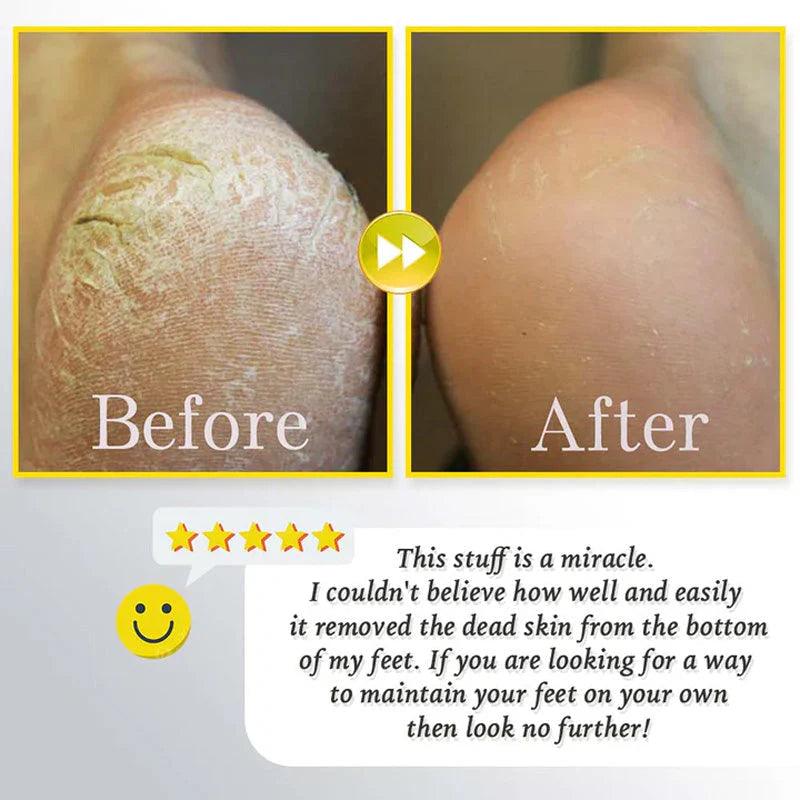🔥HOT SALE 49% OFF🔥Rechargeable Electric Foot Exfoliating Scrubber - clarioy