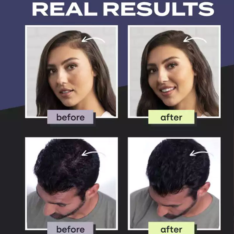 ⏰🔥LIMITED TIME 50% OFF!🔥50K+ SOLD! Hair Building Fibers Set for Thinning Hair & Bald Spots